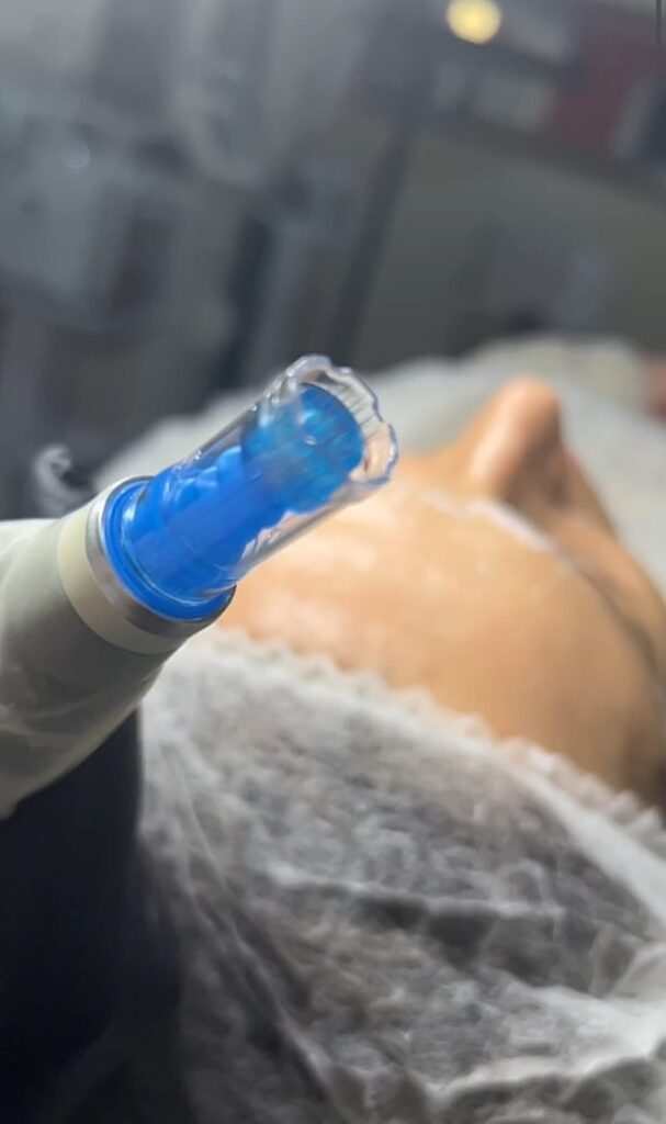 Dermapen – sekret młodej, jędrnej skóry. Jak działa mezoterapia mikroigłowa i dlaczego warto ją wypróbować?