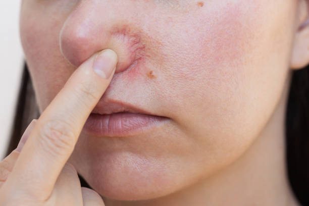 Popękane naczynka na twarzy i rumień – skąd się biorą i jak skutecznie je usunąć?