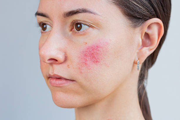 Rumień na twarzy – dlaczego pojawia się wiosną? Poznaj jego przyczyny i sposoby leczenia