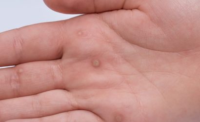 A flat wart commonly found on the hands and feet of children and young adults. They are caused by a type of human papillomavirus HPV