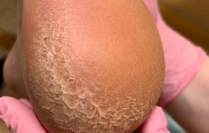 stopy problematyczne